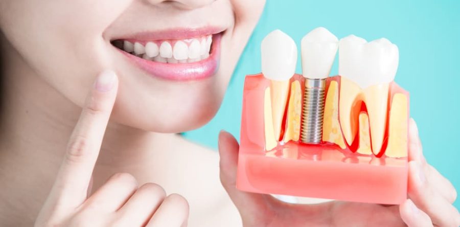 The 5 Benefits of Dental Implants | Carlingwood Dental Centre